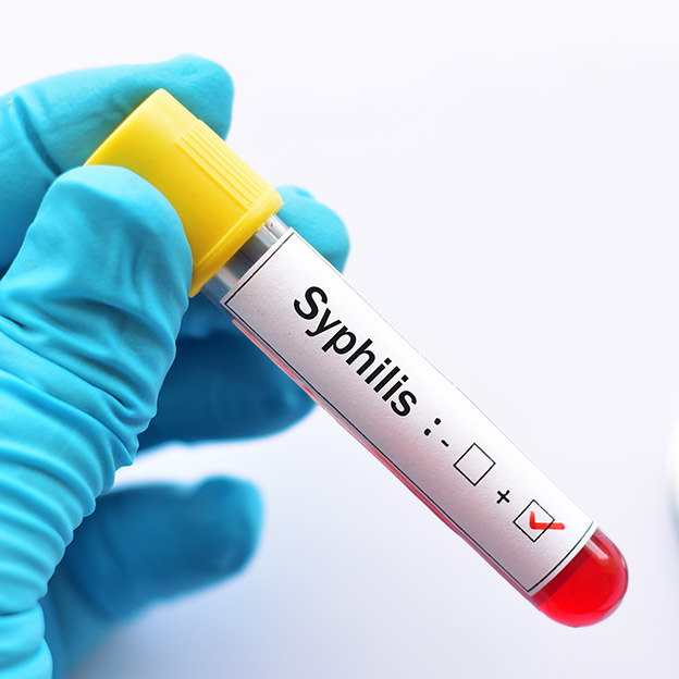 Enfermedades de Transmision Sexual (ETS) - Sífilis (VDRL) - Analisis365
